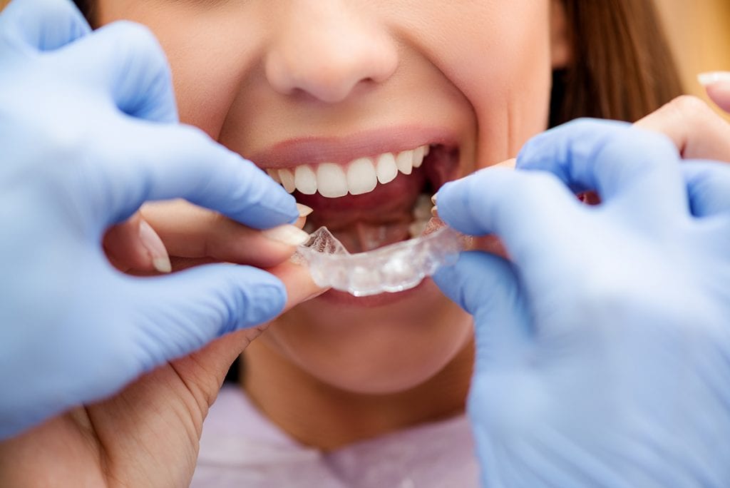 BCOH_Am_I_a_Candidate_for_Invisalign