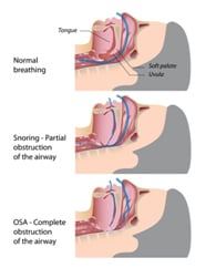 OSA Health Risks