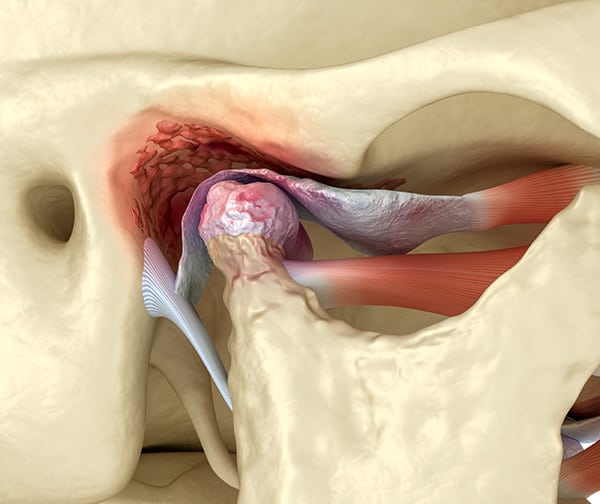 BCOH TMJ Treatment