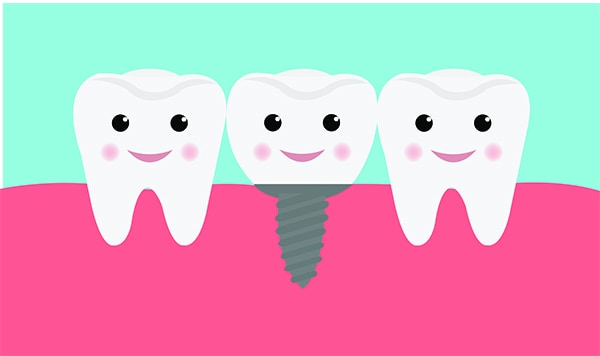BCOH_Dental_Implant_Services