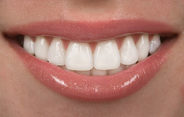 BOH_Dental_Veneer_Services